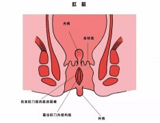 南宁做痔疮手术要多少钱？