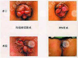 内痔究竟选择哪种疗法较好?
